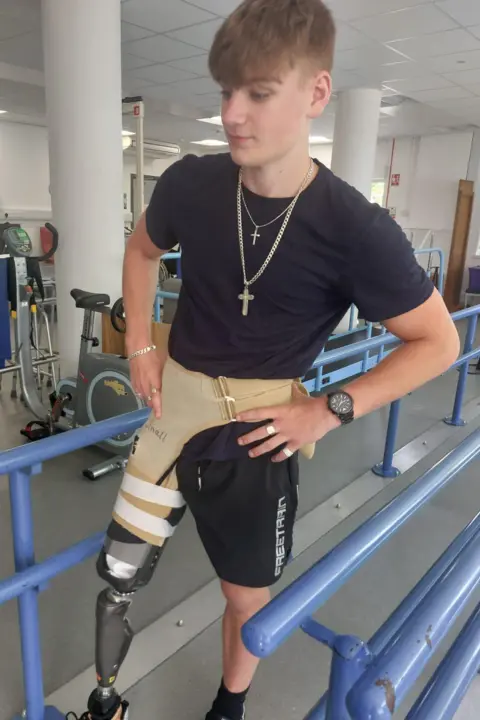 Kerry Bolton Oliver showing his prosthetic leg