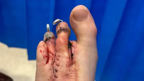 Stuart Anderson A left foot following surgery, with a disformed big toe, a toe missing and two other toes pinned, with scares running down the foot.